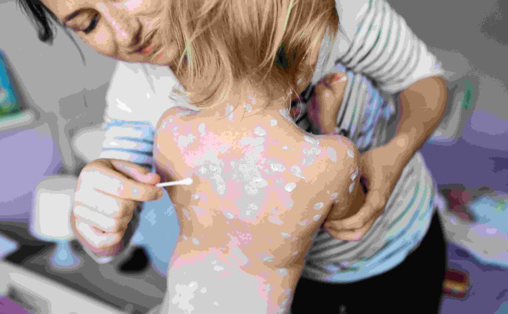 Measles Outbreak