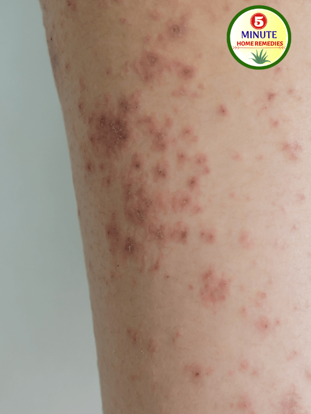Eczema