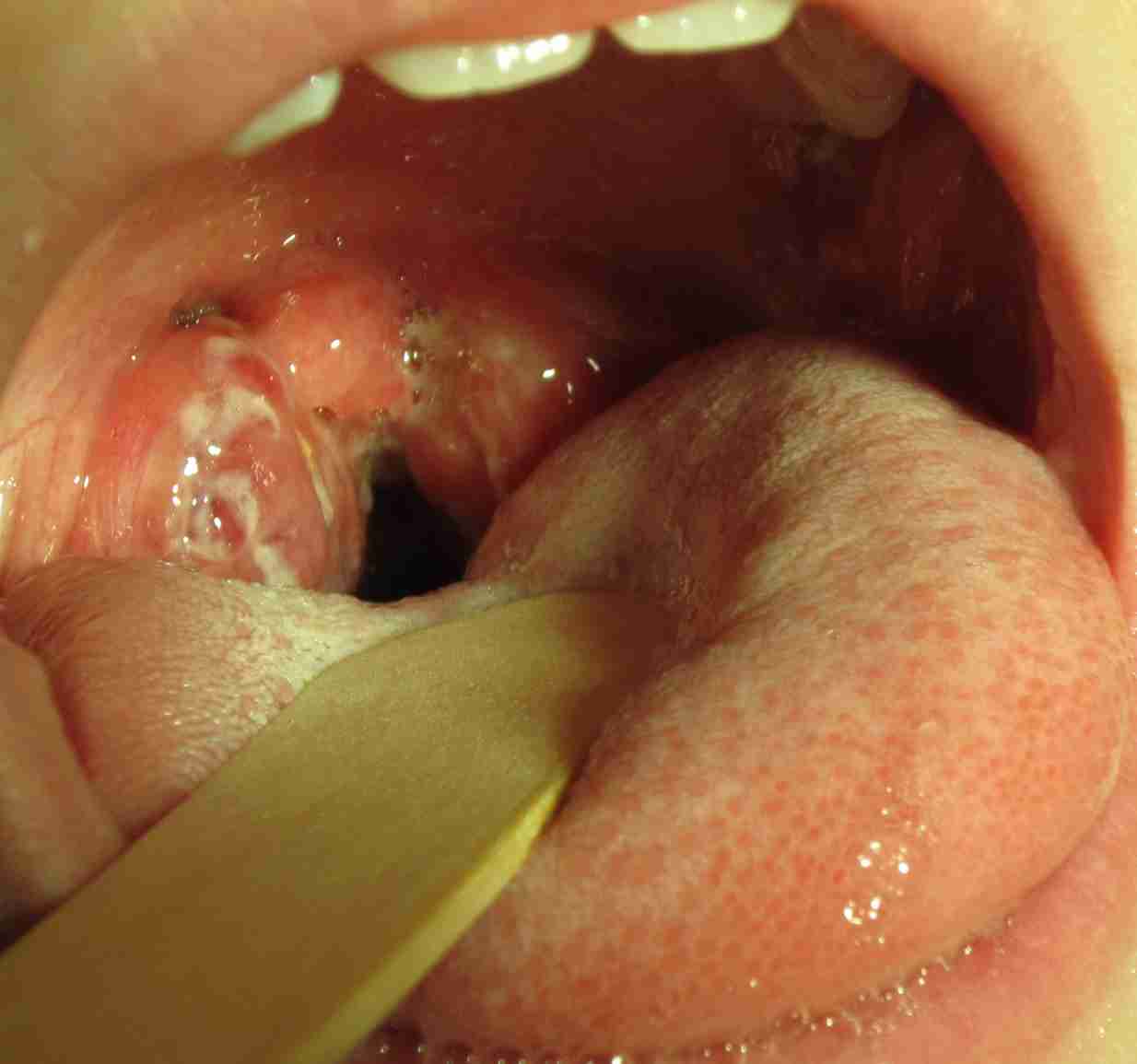Strep_throat2010